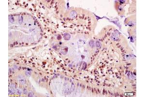 Formalin-fixed and paraffin embedded human gastric cancer labeled with Anti-FZR1/CDC20C Polyclonal Antibody, Unconjugated (ABIN1714172) at 1:200 followed by conjugation to the secondary antibody and DAB staining (FZR1 anticorps  (AA 141-240))