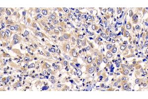 Detection of CTSK in Human Liver cancer Tissue using Polyclonal Antibody to Cathepsin K (CTSK) (Cathepsin K anticorps  (AA 71-319))