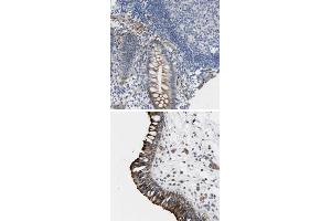 Immunohistochemical staining of human nasopharynx with TWISTNB polyclonal antibody  shows strong cytoplasmic and membranous positivity in respiratory epithelial cells at 1:200-1:500 dilution. (TWIST Neighbor anticorps)
