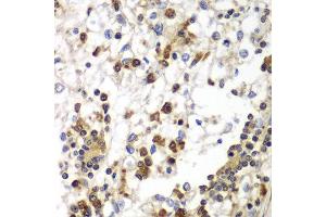 Immunohistochemistry of paraffin-embedded human kidney cancer using SND1 antibody at dilution of 1:100 (40x lens). (SND1 anticorps)