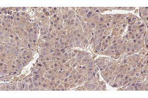 ABIN6279265 at 1/100 staining Human liver cancer tissue by IHC-P. (CATSPER4 anticorps  (Internal Region))