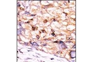 Formalin-fixed and paraffin-embedded human cancer tissue reacted with the primary antibody, which was peroxidase-conjugated to the secondary antibody, followed by DAB staining.