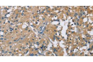 Immunohistochemistry of paraffin-embedded Human thyroid cancer using CAB39L Polyclonal Antibody at dilution of 1:40 (CAB39L anticorps)
