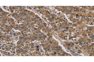 Immunohistochemistry of paraffin-embedded Human liver cancer tissue using JAG2 Polyclonal Antibody at dilution 1:30 (JAG2 anticorps)