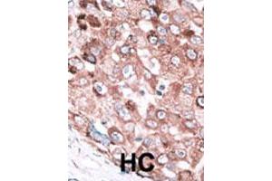 Formalin-fixed and paraffin-embedded human hepatocellular carcinoma tissue reacted with the BAK1 polyclonal antibody  , which was peroxidase-conjugated to the secondary antibody, followed by AEC staining. (BAK1 anticorps  (N-Term))