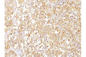 Formalin-fixed, paraffin-embedded human Melanoma stained with gp100 / Melanosome Monoclonal Antibody (SPM142). (Melanoma gp100 anticorps)