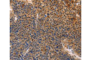 Immunohistochemistry of Human cervical cancer using MUSK Polyclonal Antibody at dilution of 1:30 (MUSK anticorps)