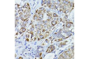 Immunohistochemistry of paraffin-embedded human liver cancer using CPT2 antibody (ABIN6129249, ABIN6138983, ABIN6138984 and ABIN6216045) at dilution of 1:100 (40x lens).