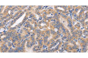 Immunohistochemistry of paraffin-embedded Human thyroid cancer tissue using CARD17 Polyclonal Antibody at dilution 1:50 (CARD17 anticorps)