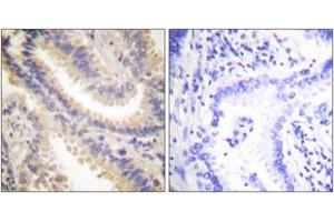 Immunohistochemistry analysis of paraffin-embedded human lung carcinoma tissue, using TIMP4 Antibody. (TIMP4 anticorps  (AA 175-224))