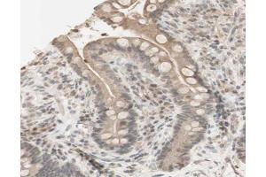 ABIN6267631 at 1/200 staining human colon cancer tissue sections by IHC-P. (PRKAA1 anticorps  (pSer486))