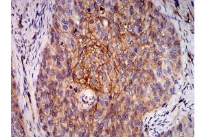 Immunohistochemical analysis of paraffin-embedded cervical cancer tissues using RALB mouse mAb with DAB staining.