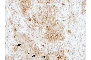 IHC-P Image Immunohistochemical analysis of paraffin-embedded human lung adenocarcinoma, using RAP1B, antibody at 1:100 dilution. (RAP1B anticorps)