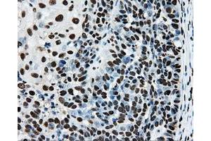 Immunohistochemical staining of paraffin-embedded Adenocarcinoma of breast tissue using anti-RPA2 mouse monoclonal antibody. (RPA2 anticorps)