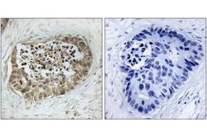 Immunohistochemistry analysis of paraffin-embedded human lung carcinoma, using SMC1 (Phospho-Ser966) Antibody.