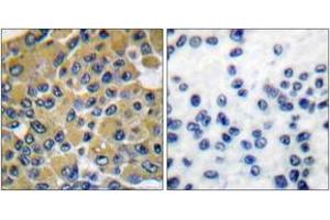 Immunohistochemistry analysis of paraffin-embedded human breast carcinoma tissue, using SHP-2 (Ab-542) Antibody. (PTPN11 anticorps  (AA 508-557))