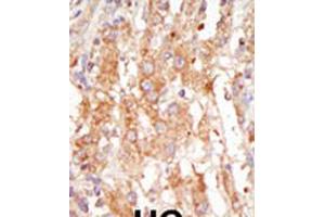 Formalin-fixed and paraffin-embedded human cancer tissue reacted with the primary antibody, which was peroxidase-conjugated to the secondary antibody, followed by DAB staining.