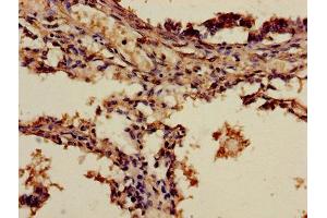 Immunohistochemistry of paraffin-embedded human lung cancer using ABIN7143652 at dilution of 1:100 (ADH7 anticorps  (AA 1-386))