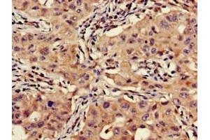 Immunohistochemistry of paraffin-embedded human lung cancer using ABIN7175463 at dilution of 1:100 (VTI1A anticorps  (AA 1-175))