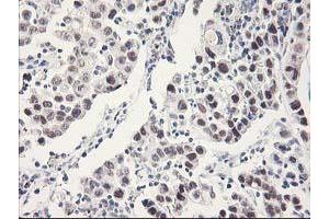 Immunohistochemical staining of paraffin-embedded Carcinoma of Human lung tissue using anti-RBBP7 mouse monoclonal antibody. (RBBP7 anticorps)
