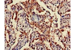 Immunohistochemistry of paraffin-embedded human lung cancer using ABIN7166452 at dilution of 1:100 (TPST1 anticorps  (AA 283-370))