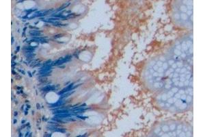 Detection of OCT4 in Human Colorectal cancer Tissue using Polyclonal Antibody to Octamer Binding Transcription Factor 4 (OCT4) (OCT4 anticorps  (AA 136-360))