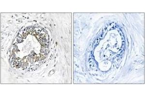 Immunohistochemistry analysis of paraffin-embedded human breast carcinoma tissue, using PAK1/2 (Ab-199) Antibody. (PAK1/2 anticorps  (AA 165-214))