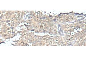 Immunohistochemistry of paraffin-embedded Human ovarian cancer tissue using MEF2D Polyclonal Antibody at dilution of 1:50(x200) (MEF2D anticorps)