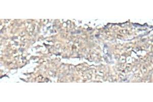 Immunohistochemistry of paraffin-embedded Human ovarian cancer tissue using MEF2D Polyclonal Antibody at dilution of 1:50(x200)