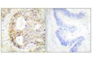 Immunohistochemistry analysis of paraffin-embedded human colon carcinoma tissue using COX41 antibody.