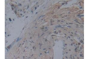 Detection of NOG in Human Pancreatic cancer Tissue using Monoclonal Antibody to Noggin (NOG) (NOG anticorps  (AA 28-232))