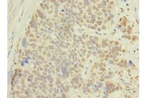 Immunohistochemistry of paraffin-embedded human gastric cancer using ABIN7143116 at dilution of 1:100