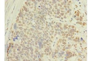 Immunohistochemistry of paraffin-embedded human gastric cancer using ABIN7143116 at dilution of 1:100 (ACTRT1 anticorps  (AA 201-376))