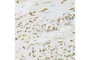Immunohistochemistry of paraffin-embedded human gastric cancer using HNRNPD Antibody.
