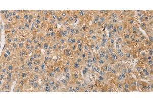 Immunohistochemistry of paraffin-embedded Human liver cancer using NFE2L1 Polyclonal Antibody at dilution of 1:30 (NFE2L1 anticorps)