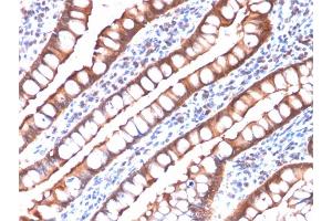 Formalin-fixed, paraffin-embedded human Small Intestinal Carcinoma stained with Villin-Monospecific Recombinant Mouse Monoclonal Antibody (rVIL1/1325). (Recombinant Villin 1 anticorps  (AA 179-311))