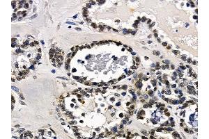 ABIN7097182 and ABIN7101250 at 1/100 staining human ovarian cancer by IHC-P. (FAM122B anticorps)