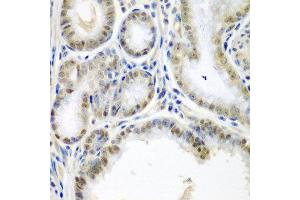 Immunohistochemistry of paraffin-embedded human colon carcinoma using SSX2 antibody at dilution of 1:200 (40x lens). (SSX2 anticorps)