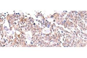 Immunohistochemistry of paraffin-embedded Human lung cancer tissue using INPP5K Polyclonal Antibody at dilution of 1:85(x200) (INPP5K anticorps)