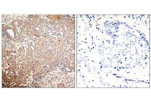 Immunohistochemical analysis of paraffin-embedded human breast carcinoma tissue using Keratin 18 (Phospho-Ser33) antibody (E011306). (Cytokeratin 18 anticorps  (pSer33))