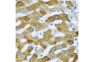 Immunohistochemical analysis of Tim17 staining in human liver cancer formalin fixed paraffin embedded tissue section.