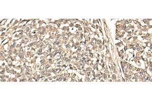 Immunohistochemistry of paraffin-embedded Human esophagus cancer tissue using BUD31 Polyclonal Antibody at dilution of 1:75(x200) (BUD31 anticorps)