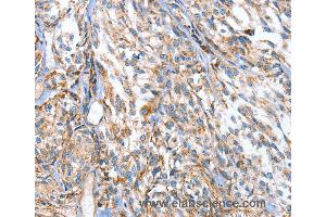 Immunohistochemistry of Human esophagus cancer using APOBEC3D Polyclonal Antibody at dilution of 1:80 (APOBEC3D anticorps)