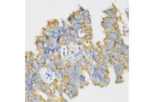 Immunohistochemistry of paraffin-embedded human rectal cancer using GHRL antibody (ABIN6131231, ABIN6141079, ABIN6141080 and ABIN6216264) at dilution of 1:100 (40x lens). (Ghrelin anticorps  (AA 1-117))
