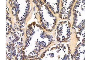 ABIN7095873 and ABIN7099935 at 1/100 staining human ovarian cancer by IHC-P.