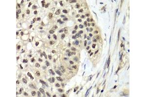 Immunohistochemistry of paraffin-embedded Human lung cancer using RFC5 Polyclonal Antibody at dilution of 1:100 (40x lens). (RFC5 anticorps)