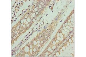 Immunohistochemistry of paraffin-embedded human colon cancer using ABIN7169114 at dilution of 1:100 (NEK8 anticorps  (AA 1-300))