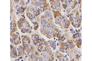 Immunohistochemistry of paraffin-embedded Human liver cancer using UGT1A9 Polyclonal Antibody at dilution of 1:200 (40x lens).