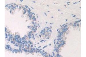 Detection of ETFb in Human Prostate Tissue using Polyclonal Antibody to Electron Transfer Flavoprotein Beta Polypeptide (ETFb)