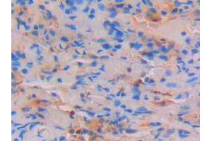 DAB staining on IHC-P; Samples: Human Lung Tissue (STAT4 anticorps  (AA 505-737))